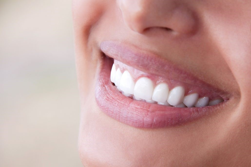 بررسی تفاوت لمینت و کامپوزیت و بلیچینگ بررسی تفاوت لمینت و کامپوزیت و بلیچینگ